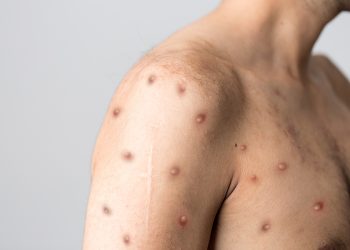 2 Warga di Tangsel Positif Cacar Monyet